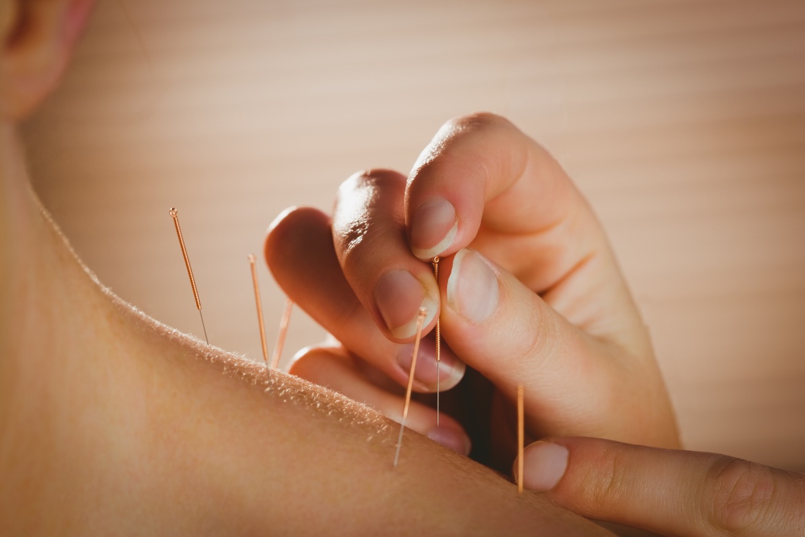 ACUPUNTURA