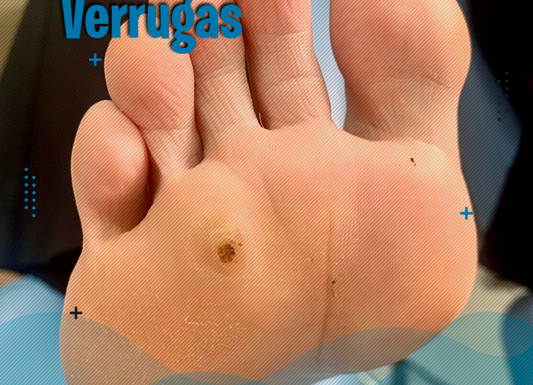 TRATAMENTO DE VERRUGAS
